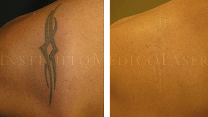 Antes y Después de tratamientos para eliminar tatuajes