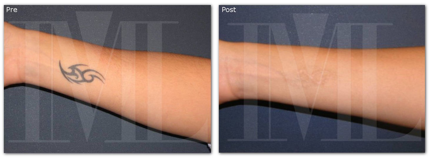 Eliminación de tatuaje con láser en brazo: foto de antes y después
