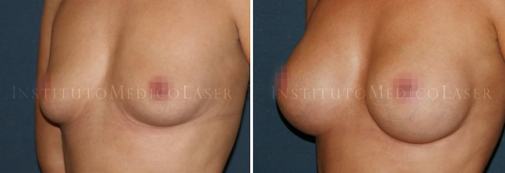 Antes y después de la mamoplastia