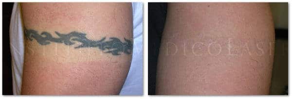 Tatuaje antes y después del tratamiento de eliminación con láser