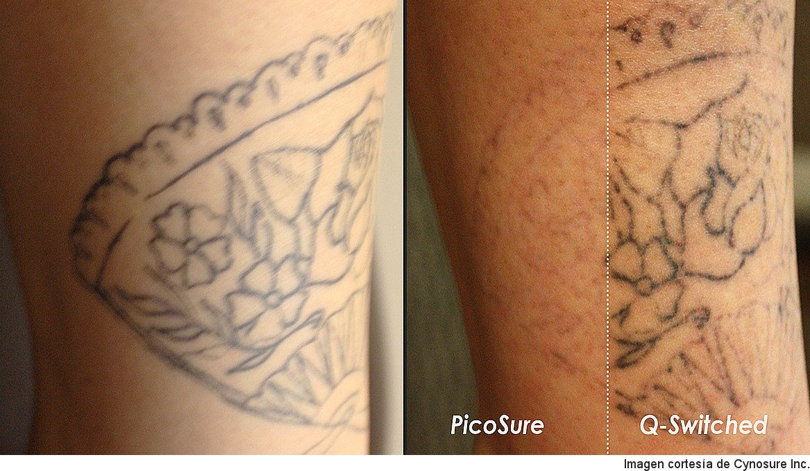 Casi muerto válvula Generosidad Eliminar tatuaje con láser Picosure, antes y después | IML