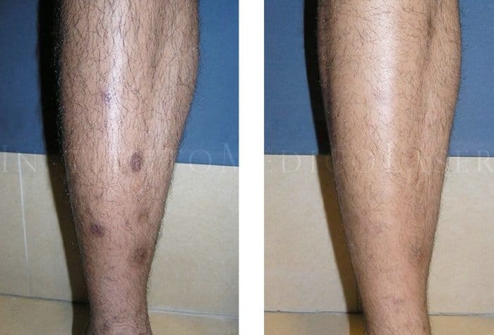 Maestro ala Imperialismo Hiperpigmentaciones en piernas: antes y después | IML