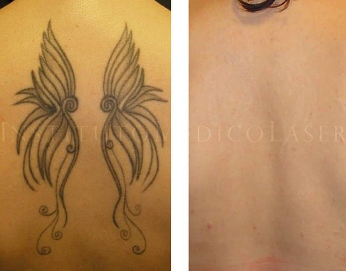 Antes y después de quitar un tatuaje con láser