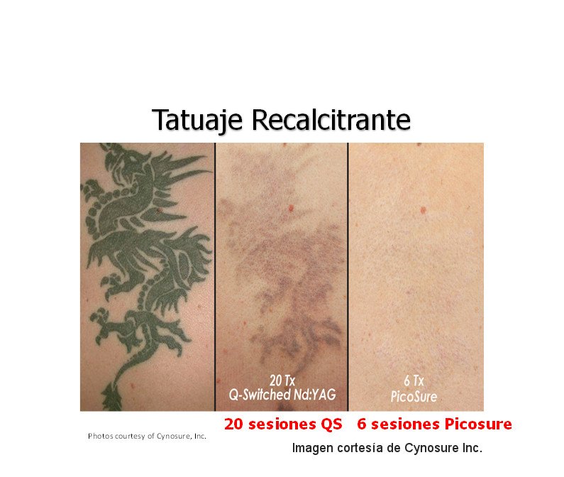 Eliminación de tatuaje recalcitrante, antes y después