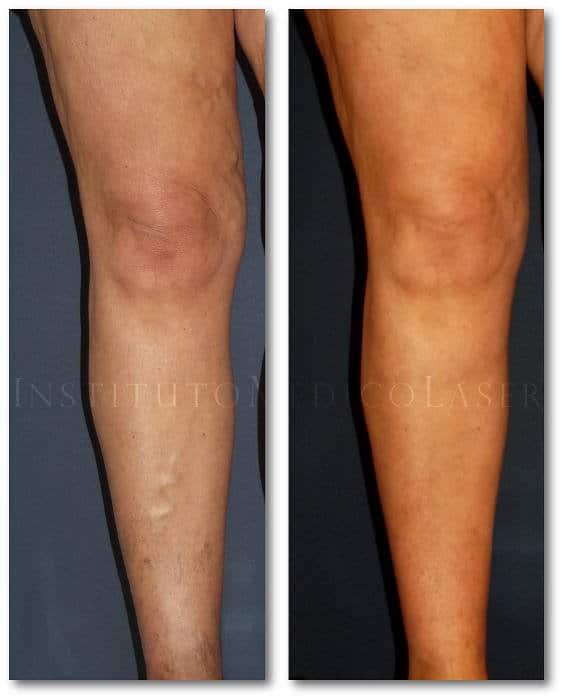 Retener compacto Cayo Antes y después del tratamiento de varices en las piernas | IML
