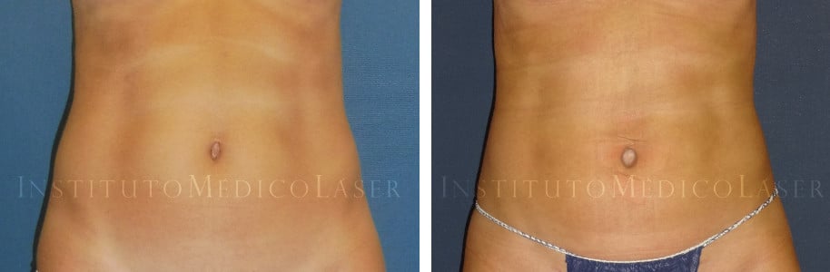 Renuvion en abdomen, antes y después