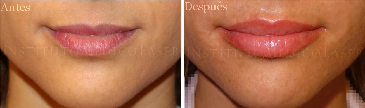 Relleno de labios antes y después