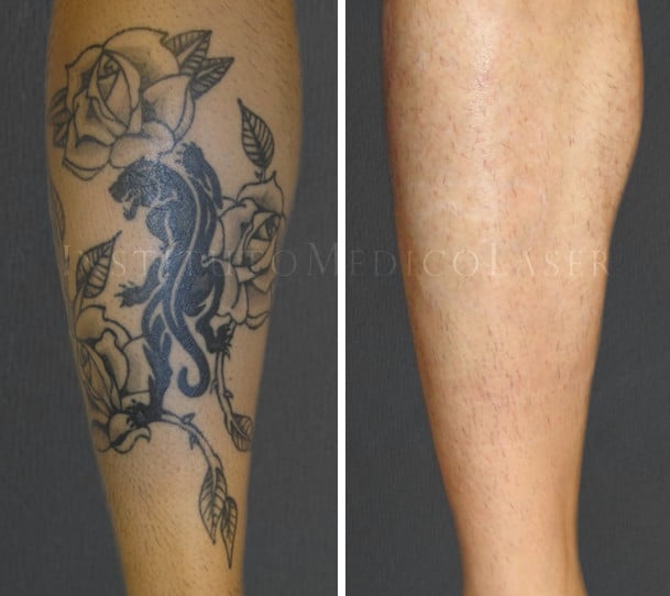 Resultados pre y post láser para tatuajes
