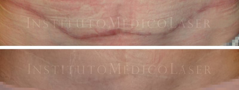 Cicatriz, antes y después del tratamiento con láser