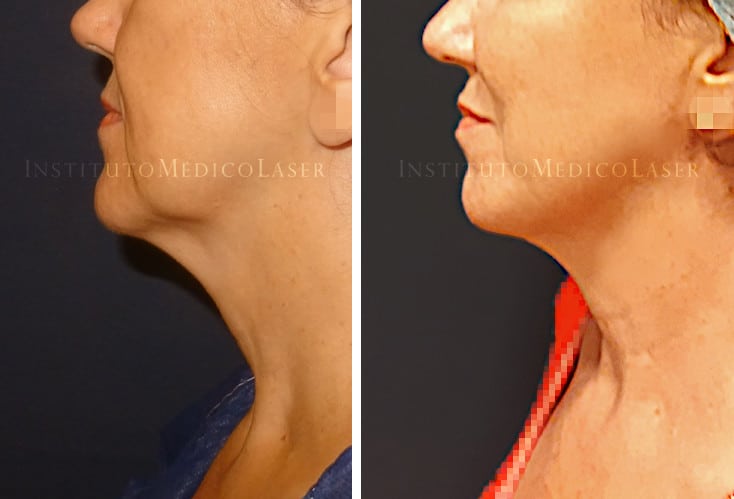 cruzar dilema Empresario Rejuvenecimiento facial sin cirugía, antes y después | IML