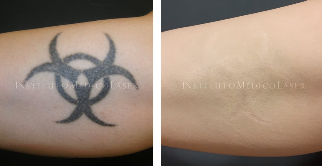 Antes y Después de tratamientos para eliminar tatuajes