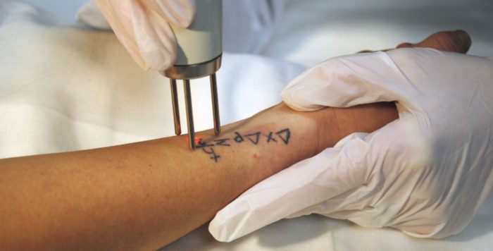 eliminando tatuaje con laser