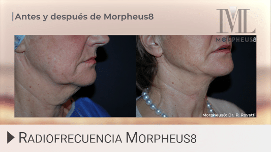 Cómo funciona Morpheus8