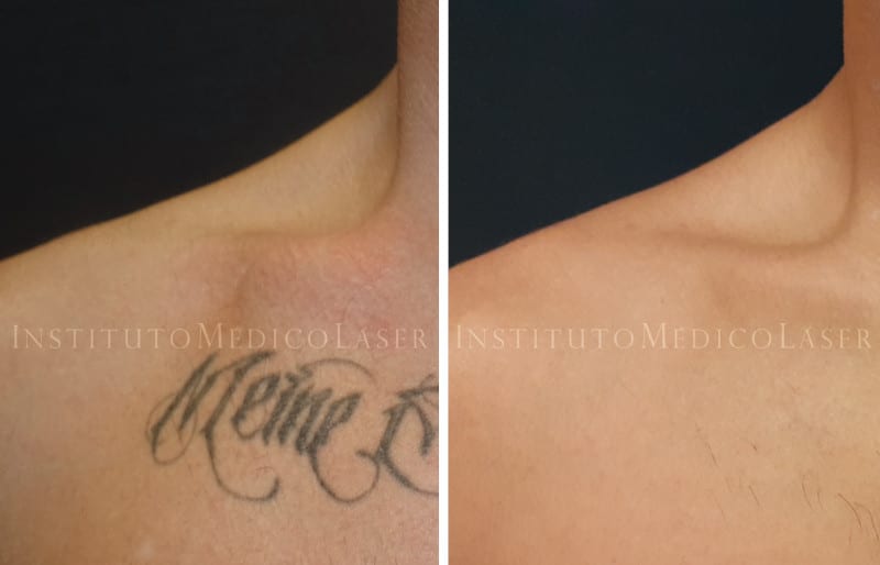 Tatuaje eliminado antes y despues