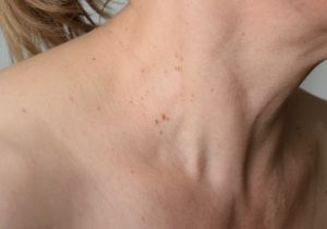 Eliminar angiomas