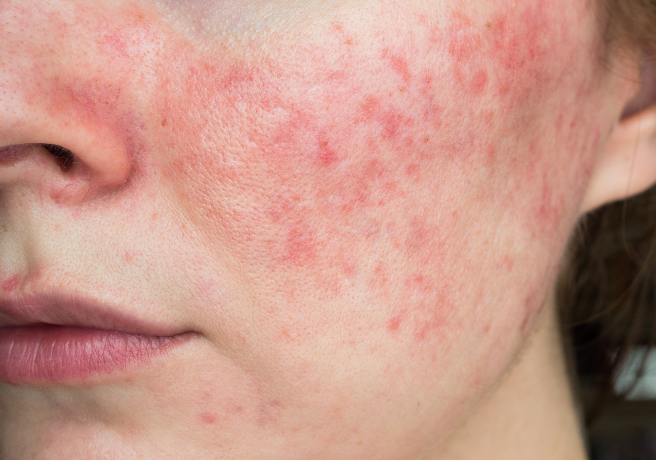 Tratamientos para eliminar la Rosacea IML