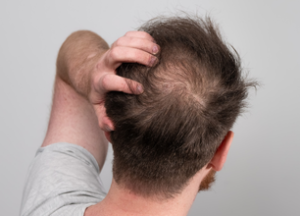 DHI Direct Hair Implantation