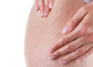 Eliminación de Estrías