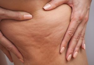 Eliminar la celulitis
