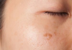 Tratamiento del melasma
