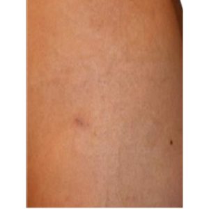 Antes y después de Picosure en tatuaje - 4 sesiones