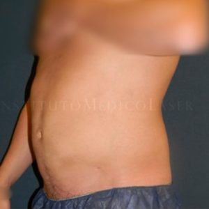 Abdomen antes y después de Lipoláser
