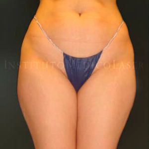 Antes y después de reducir abdomen, caderas y muslos