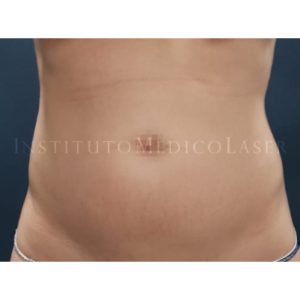Pre y post abdomen plano con Lipovaser