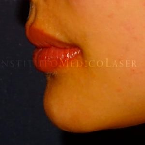 Antes y después del Ácido hialurónico en labios