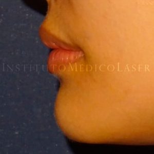 Antes y después del Ácido hialurónico en labios