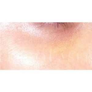 Resultados antes y después de Ácido hialurónico para ojeras