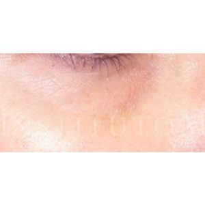 Resultados antes y después de Ácido hialurónico para ojeras
