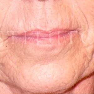 Tratamiento de arrugas en la cara, antes y después