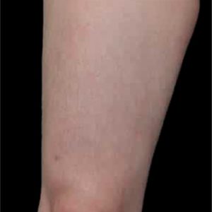 Tratamiento de la celulitis en muslos