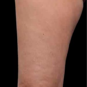 Tratamiento de la celulitis en muslos