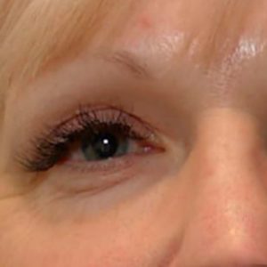 Contorno de ojos, antes y después con Morpheus8