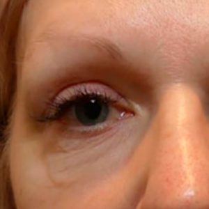 Contorno de ojos, antes y después con Morpheus8
