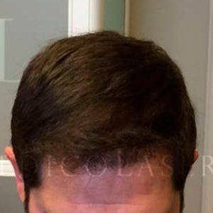 Antes y después del injerto capilar en IML (Madrid)