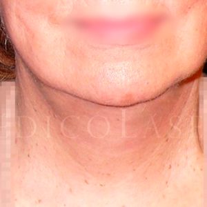 Pre y post Lifting en el cuello