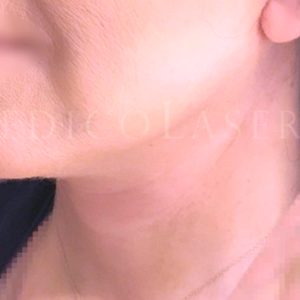 Antes y después Lifting facial