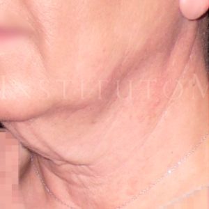 Antes y después Lifting facial