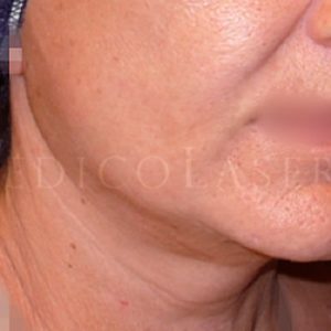 Antes y después del neolifting facial y cuello