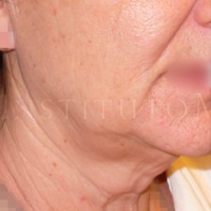 Antes y después del neolifting facial y cuello