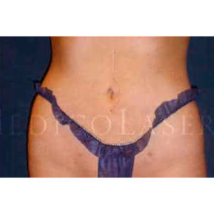Antes y después de Lipoláser en abdomen