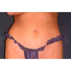 Antes y después de Lipoláser en abdomen