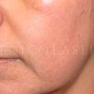 Antes y después, melasma