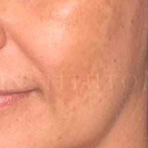 Antes y después, melasma