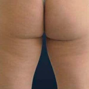 Ondas de choque en glúteos y muslos, antes y después
