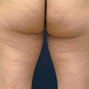 Ondas de choque en glúteos y muslos, antes y después