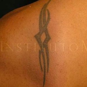 Antes y después de quitar un tatuaje